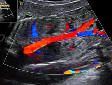 Ecocardiografia colordoppler